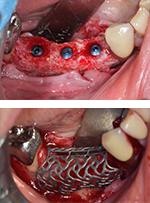 Grilles 3D