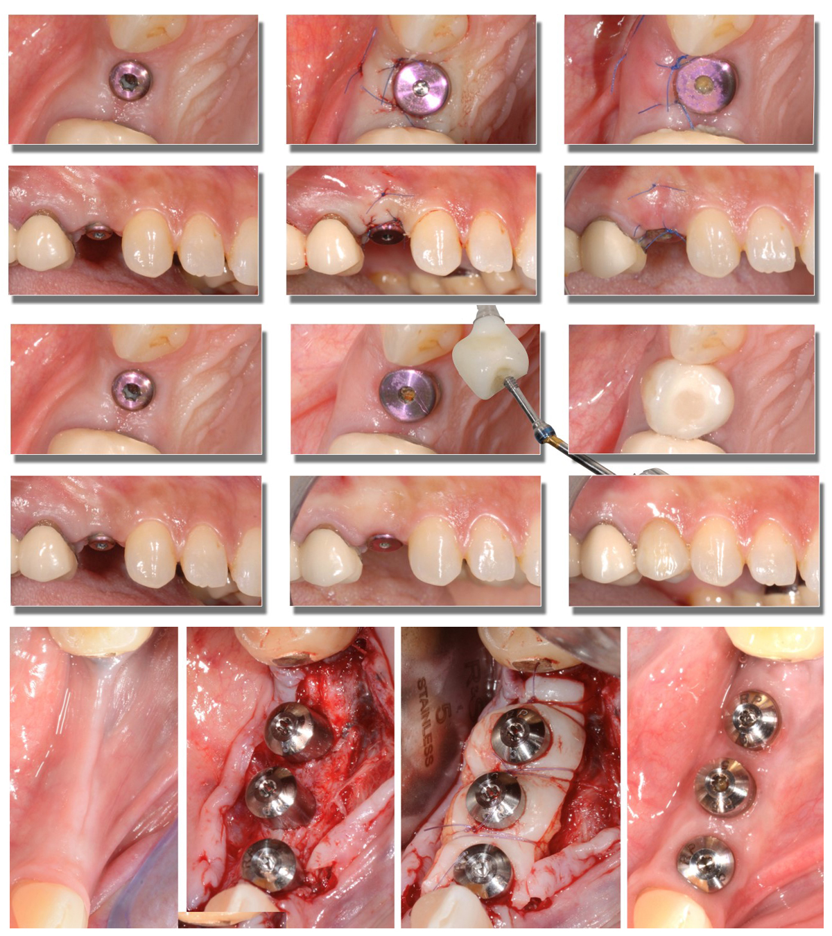 Chirurgie muco-gingivale