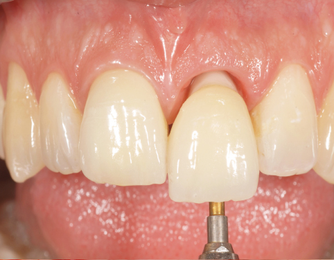 Implant unitaire