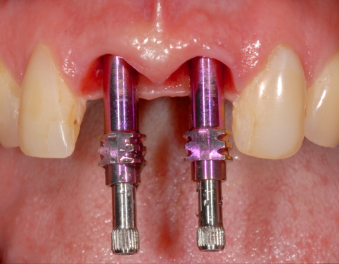 Implants multiples